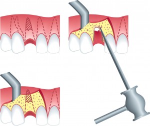 Root Canals